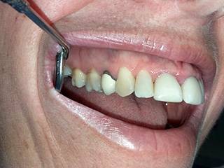 Restauration des dents  par CFAO