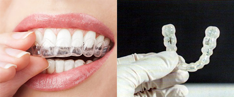 Soins d'orthodontie