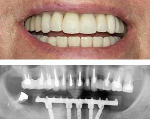 Les implants dentaires 