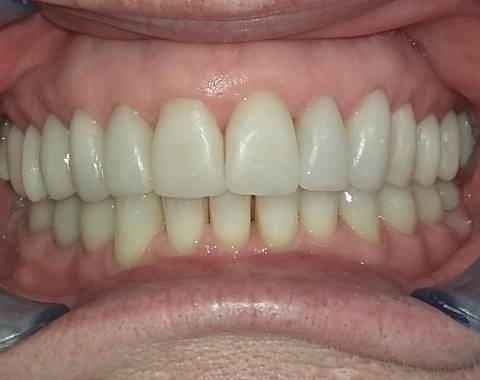 Restauration des dents  par CFAO